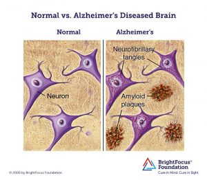 Альцгеймера болезнь причины возникновения и лечение